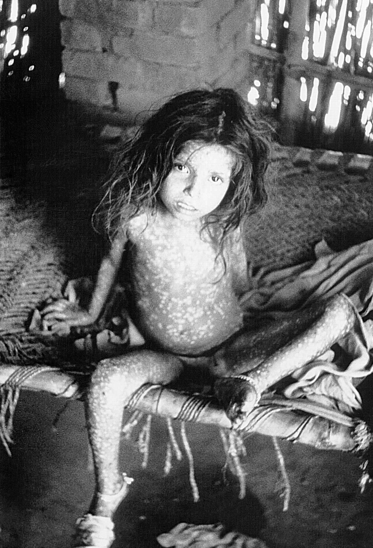 A young child showing a widespread rash caused by ordinary-type smallpox.