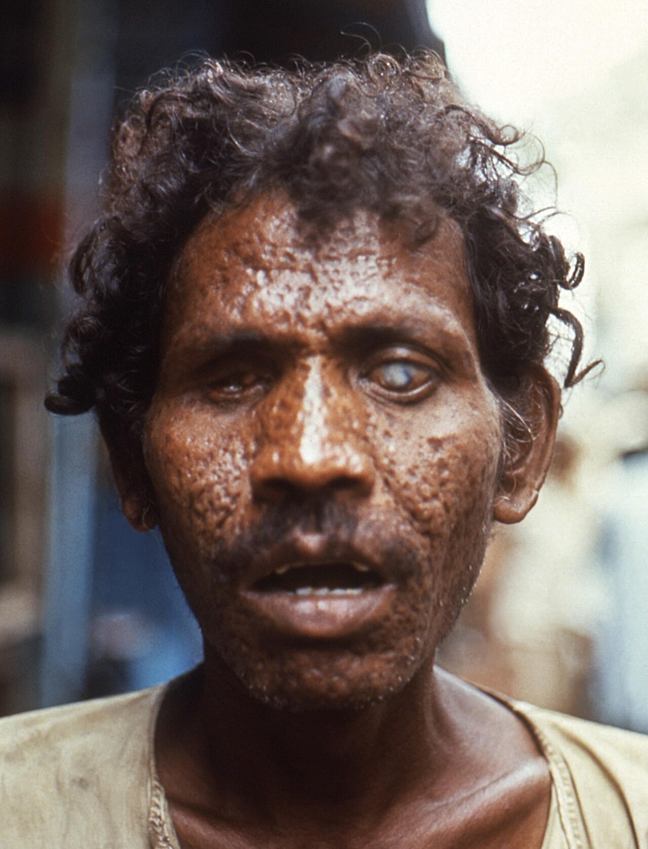 Adult survivor displaying severe facial scarring and corneal blindness caused by smallpox in 1972.